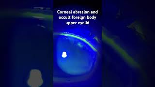 Corneal abrasion and occult foreign body under the upper eyelid protectingsight ophthalmology [upl. by Ettenil534]