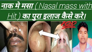 Nasal Polyps नाक मे मसा  Nasal mass with Hit  का पुरा इलाज कैसे करे। Abhia2zmedical [upl. by Ardnait895]