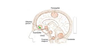 Meningiomas Signs Symptoms and Advanced Treatment Options [upl. by Kussell409]