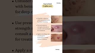 GLOW UP series NODULAR ACNE Beginner friendly Part 6 acnepositivity acnedoctor acneproneskin [upl. by Majka161]