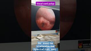 Vocal cord polyplaryngoscopyvoicechangeentlaservoiceoveruseteacherhawkerentdoctoryoutube [upl. by Glenna341]