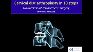 Cervical Spine Disc Arthroplasty  Latest Joint Replacement Surgery in the Neck [upl. by Dolph]