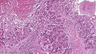 Hepatocellular Carcinoma  Histopathology [upl. by Anairdna]