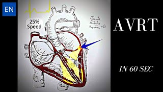 Atrioventricular Reentrant Tachycardia AVRT Animation and ECG Shorts [upl. by Enelrad]