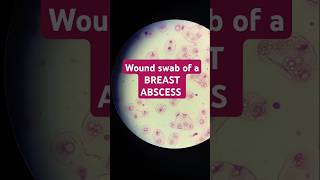 GRAM STAIN OF A BREAST ABSCESS microbiology breastcancer [upl. by Airrehs]