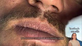 blackheads mout blackheads mouth lip blackheads mouth area blackheads mouth removal [upl. by Ecyob92]