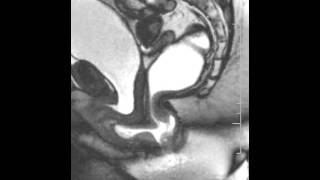 Dynamic Pelvic MRI showing rectocele Pelvic Floor Center of Orlando [upl. by Itaws775]