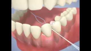 Austin Dental Bridge  Flossing with a Dental Bridge [upl. by Aubigny43]