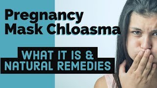 Pregnancy Mask Chloasma What It Is amp Natural Remedies [upl. by Bambi479]