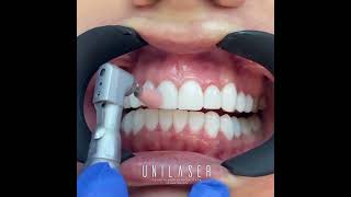 Creating shiny smiles  Bonding veneers composite veneers [upl. by Lenej]