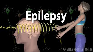 Epilepsy Types of seizures Symptoms Pathophysiology Causes and Treatments Animation [upl. by Bartosch137]