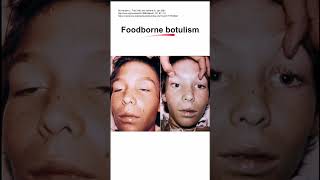 Foodborne botulism [upl. by Goltz469]