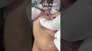 Mole Treatment Guide Safely Remove Moles from Your Skin AWISH Clinic [upl. by Atilrep]