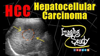 Hepatocellular Carcinoma on the background of CLD  Ultrasound  Case 179 [upl. by Gable329]