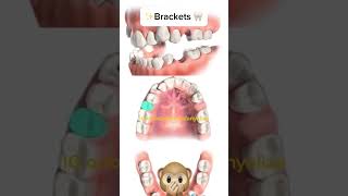 Second premolars extraction orthodontie kieferorthopädie orthodontics ortodonzia ortodoncia [upl. by Zenda]