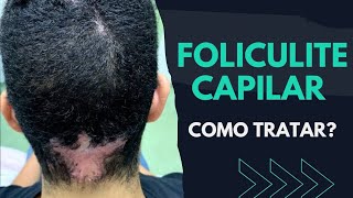 FOLICULITE CAPILAR Como Tratar  SAIBA NESSE VÍDEO [upl. by Imotih767]