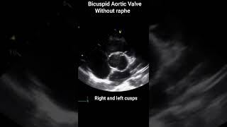 Bicuspid Aortic Valve [upl. by Yrral]