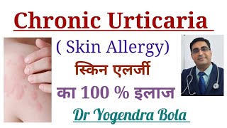 Chronic Urticaria Skin Allergy के कारण and Complete Treatment in Hindi [upl. by Gigi805]