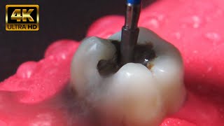 4K AMAZING alternative to rebuilding decayed teeth inlay [upl. by Aisemaj]