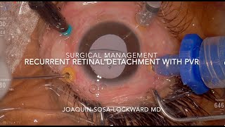 Clip 27 Recurrent Retinal detachment with PVR and inferior retinectomy [upl. by Romulus]