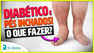 Diabético com PÉS INCHADOS O que fazer 🦶🏼🚫 [upl. by Libb]