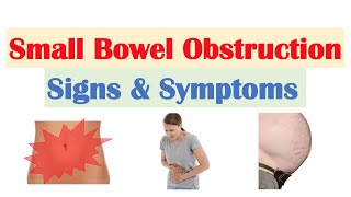 Small Bowel Obstruction SBO Signs amp Symptoms amp Why They Occur [upl. by Irodim]