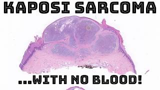 Tricky Nodular Kaposi Sarcoma  NO extravasated blood pathology dermatology dermatopathology [upl. by Streeter663]