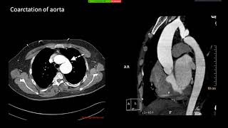 Imaging in Phakomatosis [upl. by Aicenek]