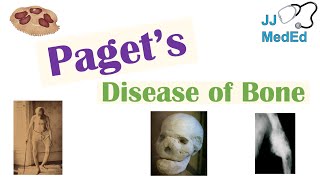 Paget’s Disease of Bone Osteitis Deformans  Causes Pathogenesis Symptoms Diagnosis amp Treatment [upl. by Amos]