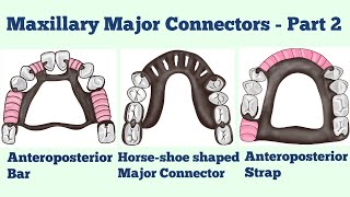 Maxillary Major Connectors Part2 Anteroposterior BarHorseshoe shapedAnteroposterior Strap [upl. by Vinia329]