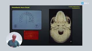 Las leyes de Planas Rehabilitación neurooclusal [upl. by Anelah]