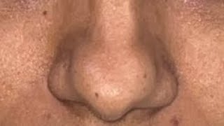 Bulbous Nose Rhinopalsty a classical Tip plasty surgical steps [upl. by Amik]