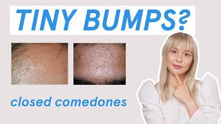 Why those tiny bumps AREN’T fungal acne [upl. by Mandy]