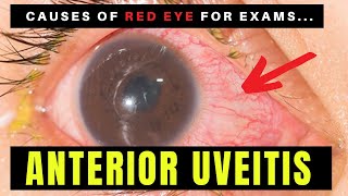 Causes of Red Eye  Part 2 ANTERIOR UVEITIS Iritis [upl. by Chally250]