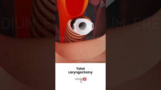 Laryngectomy Throat Cancer Surgery ↪ 3D Medical Animation Shorts Laryngectomy Throat Surgery [upl. by Hilary]