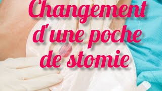 Définition et changement dune poche de colostomie [upl. by Lesya]