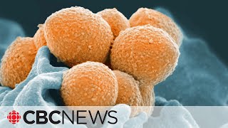 Invasive cases of Group A strep soar to record levels [upl. by Nathanson]