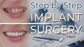 Dental Implant Surgery  Step by Step 67 Gluing the Onlay 13 Anterior Canine Guidance [upl. by Pippy]