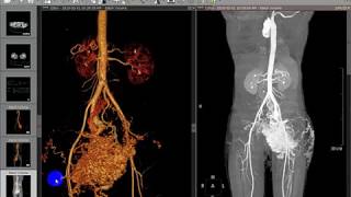 CT Angiography Case10 Vascular Malformations  AVM and Hemangioma [upl. by Barr]