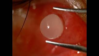 AIOC2024  VT490  Dr Birendra Prasad Kashyap  Subconjunctival cysticercosis recognition and [upl. by Lewin]