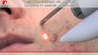 ACNE VULGARIS TREATMENT Fotona Lightwalker NdYAG laser [upl. by Gayler77]