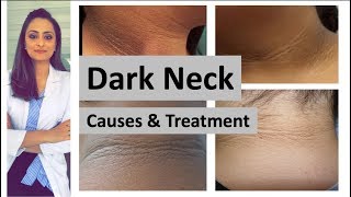 dark neck  causes treatment  Home remedies  Dermatologist Dr Aanchal Panth [upl. by Pernell]