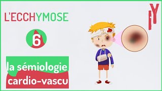 EPISODE6 sémiologie cardiovasculaire LECCHYMOSE [upl. by Harat737]