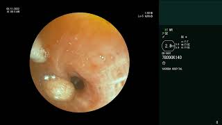 Endobronchial Carcinoid  Bronchoscopic retrieval [upl. by Reisch]