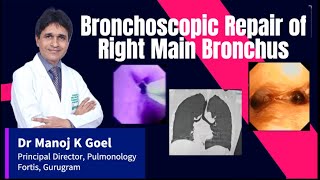 Bronchoscopic Dilatation Bronchial Stenosis Dr MANOJ GOEL lungcancer tuberculosis bronchoscopy [upl. by Gaile]