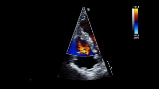 Ventricular Septal Rupture After Acute Myocardial Infarction [upl. by Millur]