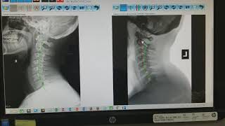 경추 목 Cervical Spine 척추엑스레이보는법 [upl. by Ynnos]