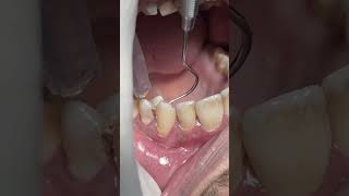 Dental problem of food impacts in deep caries dentist [upl. by Nnylkoorb374]