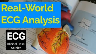 RealWorld ECG Analysis Clinical Case Studies in Electrocardiography [upl. by Giustino]