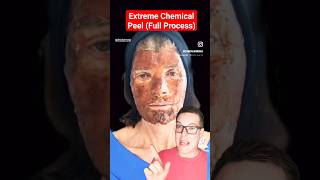 ALARMING CHEMICAL PEEL  Full Phenol Peel Process shorts [upl. by Suk171]